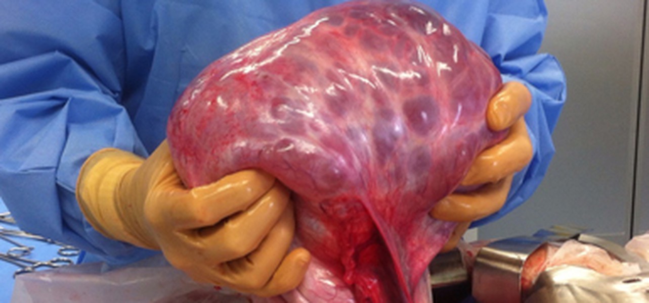 Le Cas De La Semaine Tumeur Benigne De L Ovaire Droit